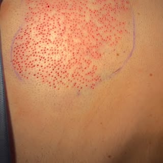 Today’s case is a Chest Harvest. When scalp donor hair is limited, chest and body hair can potential