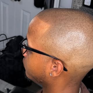 SMP + your barber = a team. 💈🤝

Why men love it:
▪️ results after session one
▪️ no surgery, no do