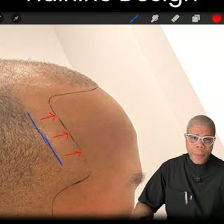 Watch a hairline get rebuilt from the ground up. 👇

This client came in with years of recession and