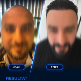 Före. Process. Efter. 💛

Bakom varje resultat finns hundratals små beslut som gör den stora skillna