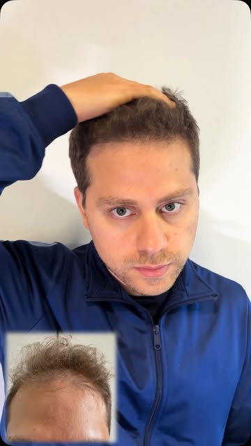Transplante capilar de alto padrão é aquele que se torna imperceptível até aos olhos mais atentos.

