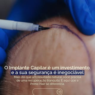 O Transplante Capilar é um passo importante. Você merece mais do que um bom resultado estético: você