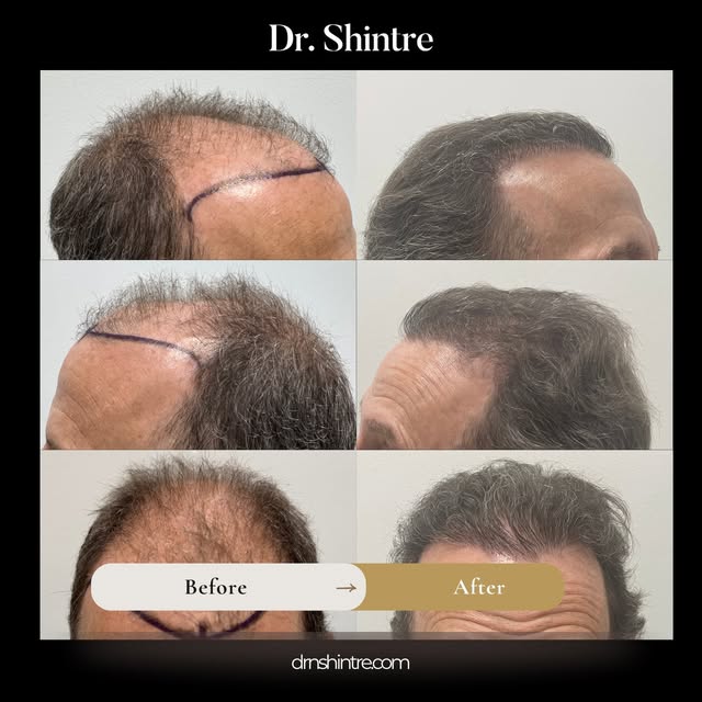 6 months. 2,500 grafts. Hairline, midscalp, and crown restored.

FUE with stem cells by Dr. Shintre 