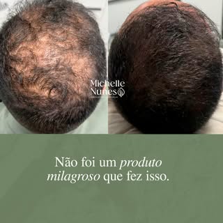 A queda capilar pode ter diferentes causas — e nem toda queda significa a mesma coisa.

Pode ser um 