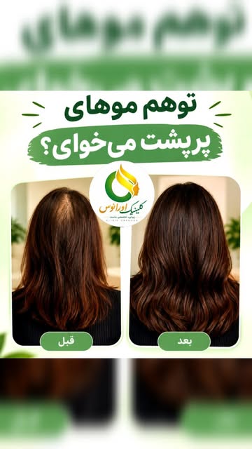 ✨ خداحافظی با موهای ضعیف و کم‌پشت!
فیلر مو با تخفیف ویژه در کلینیک اورانوس 💜
اگر موهات کم‌پشت شده، 