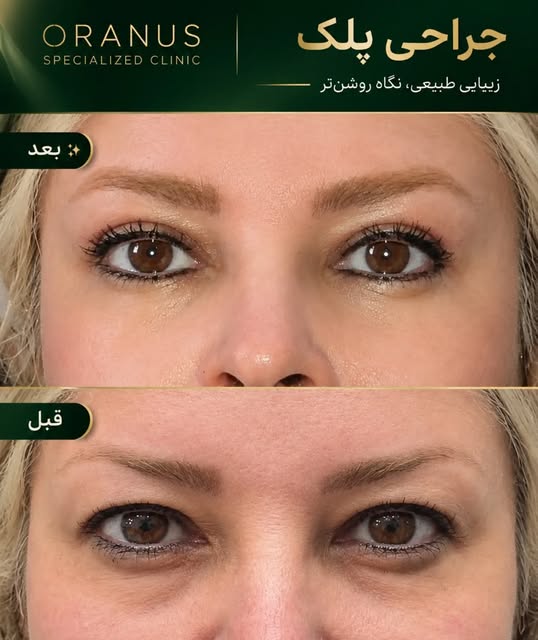 با جراحی پلک می‌توان افتادگی و پف ناحیه پلک را اصلاح کرد و به چهره ظاهری بازتر و جوان‌تر بخشید.
هدف،