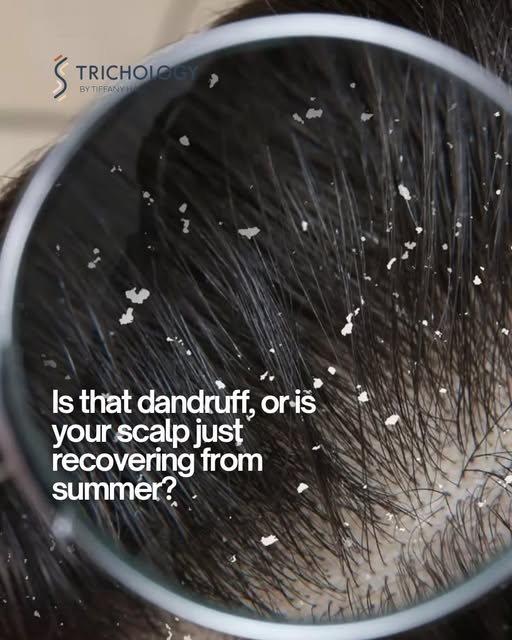 Your scalp’s still recovering from summer, even if you don’t realise it.

That flaking might not be 