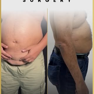 Stubborn Fat নিয়ে আর দুশ্চিন্তা নেই! অল্প সময়ে, সহজেই বডির এক্সট্রা ফ্যাট রিডিউস করুন Este Liposucti
