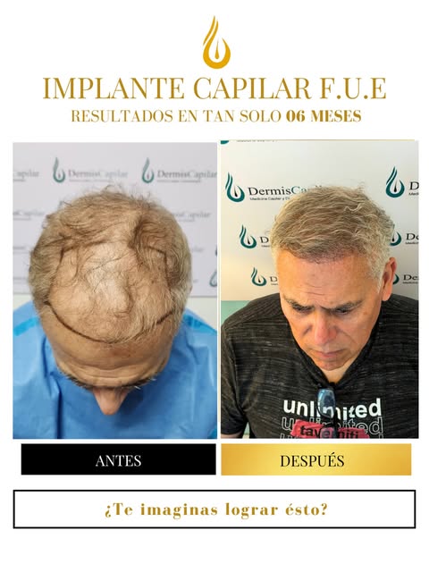 ✨ RESULTADO A LOS 6 MESES ✨

Paciente : Spena Alfredo 

Un cambio visible, natural y progresivo.
Est