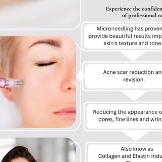 #microneedling #confidence #youarebeautiful #shannoncrottyskinclinic