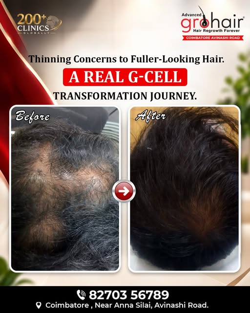 ✨ From Hair Thinning Concerns to Fuller-Looking Hair ✨

Witness a real hair transformation journey w