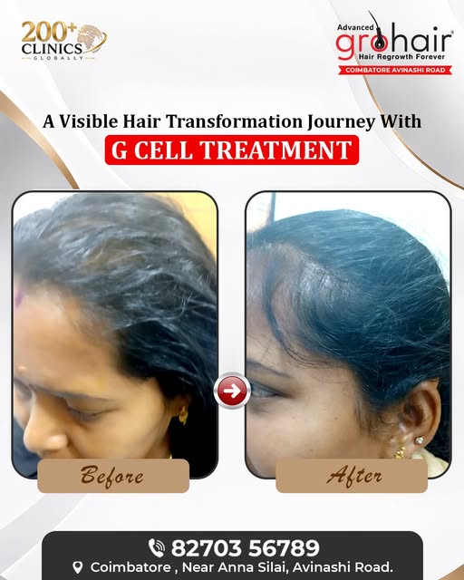 ✨ A Visible Hair Transformation Journey with G-Cell Treatment ✨

Hair thinning concerns can have dif