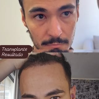 Resultado do meu transplante capilar 
5 meses depois (feito em 26 de março de 2026)

@draanakikuchi
