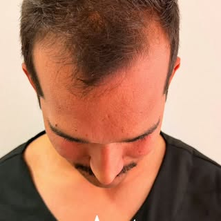 Do planejamento à transformação.

Um transplante capilar bem realizado começa muito antes da cirurgi