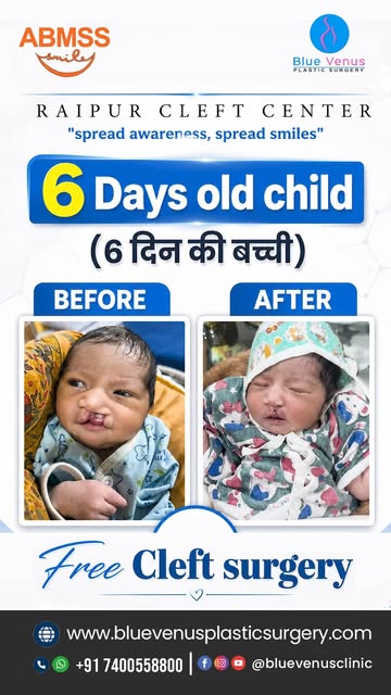 🤍 Just 6 days old. Already beginning a journey toward cleft lip care.

This patient story offers a 