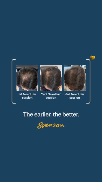 Your reminder to stop putting it off! ⏰

When it comes to your scalp, waiting isn't always the best 