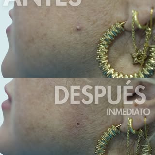 Mismo rostro, piel más limpia y uniforme. ✨

A veces, una pequeña imperfección en la piel puede ser 