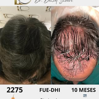 🌟Un resultado natural y excepcional: 2275 unidades foliculares en un solo día, sin rapar el pelo. 
