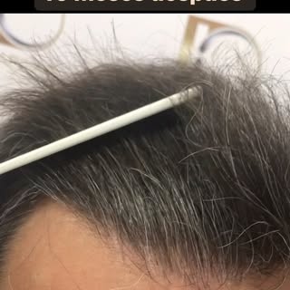 🌟Resultado de un Trasplante Capilar FUE-DHI llevado a cabo por el Dr. Daniel Sucari en DKapilar Cli