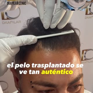 ✨🌟 En DKapilar Clinic, creemos que un trasplante capilar exitoso va más allá de la cantidad de pelo