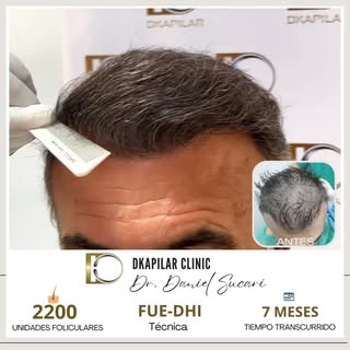 😍¡Transformación sorprendente en solo 7 meses! 💯 
👨‍⚕️Con el increíble trabajo del Dr. Daniel Suc