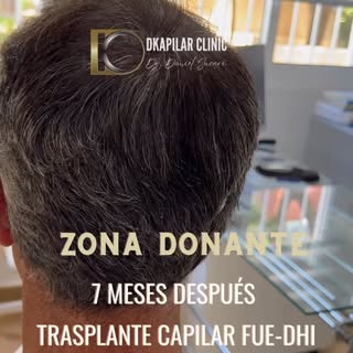 👉👀 Es común ver imágenes de la zona receptora una vez realizado el trasplante capilar, creemos que