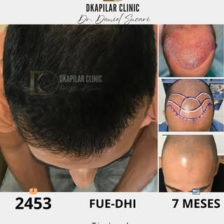😃Nuestros trasplantes capilares FUE-DHI con implantadores brindan una densidad y naturalidad que ca