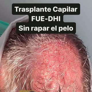 🧑🏻‍⚕️En DKapilar Clinic, El Dr. Daniel Sucari lidera el camino en trasplantes capilares sin rapar 