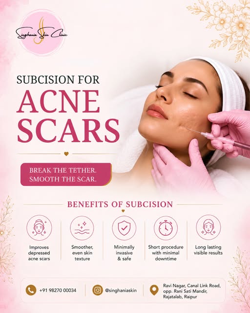 Acne scars don’t have to be permanent. ✨
Some depressed acne scars are caused by fibrous tethers ben
