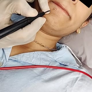 That mole you’ve been thinking about removing? 👀

Here’s a closer look at how mole removal is perfo