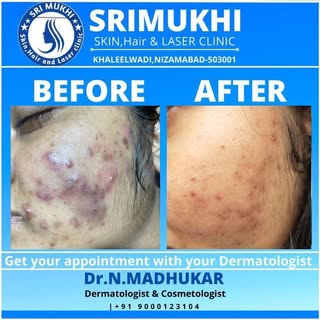 Are you suffering from Acne? 
We can help; there are many different ways to treat acne; we can go t