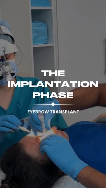 Every graft is placed with purpose.⁠
⁠
During the implantation stage, each hair is carefully positio