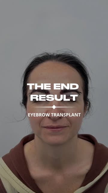 The journey doesn't end here - it's where the results begin.⁠
⁠
Following the implantation of 626 gr