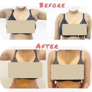 Axillary Breast is caused by the development of breast tissue outside of the normal breast area.

It