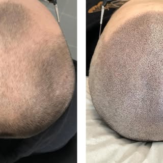 💥efekt naturalnej mikropigmentacji skóry głowy po 3️⃣ sesjach #scalpmicropigmentation 

Sesję odbyw