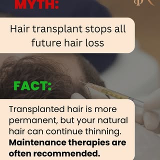 Myth vs Fact 💡 Hair Transplant Edition

Many people think a hair transplant stops all future hair l