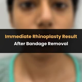 Rhinoplasty Transformation ✨💕

We performed a rhinoplasty to improve our patient’s nose shape while