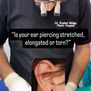 “That enlarged ear piercing isn’t permanent. ✨ A simple ear lobule repair can restore a natural-look