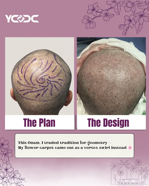 The vertex swirl: where art meets anatomy.

Getting the crown right isn’t just about placing grafts 