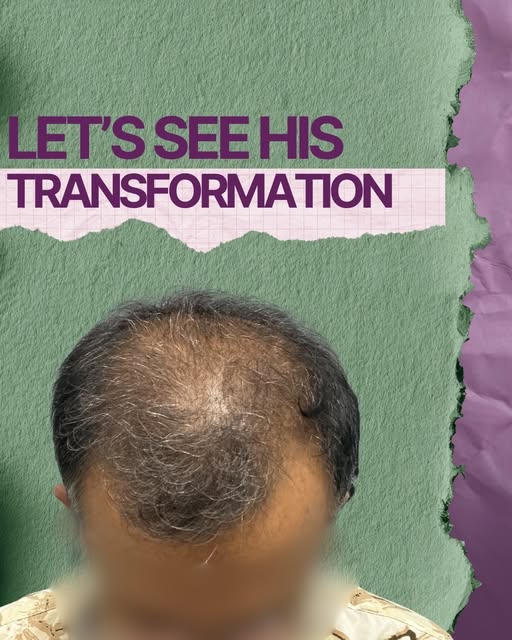 If your hair transplant is obvious, it failed the most important test. 👀
The goal isn’t to make peo