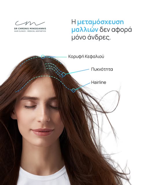 Η τριχόπτωση στις γυναίκες είναι πολύ συχνή και πολύ συνήθως δεν διαγιγνώσκεται έγκαιρα.⁠
⁠
Η αραίωσ