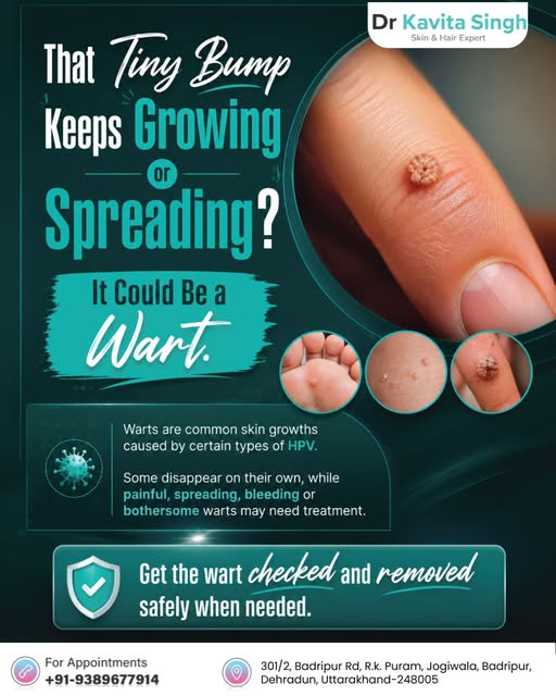 Many warts are harmless, but persistent, painful or spreading growths may benefit from professional 