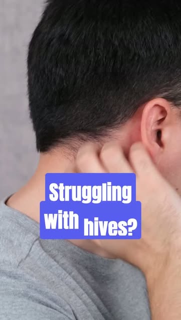 Itchy, red welts, often known as hives, can appear suddenly and are commonly triggered by allergies 