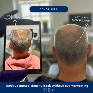 Many patients I consult with often aim for the highest number of grafts possible. But here’s the tru