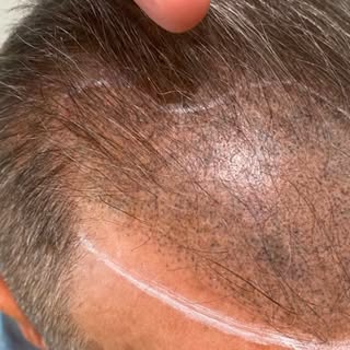 Hair Loss Made Easy! Getting started has never been simpler! Click ‘Get a Quote’ on my Instagram pag