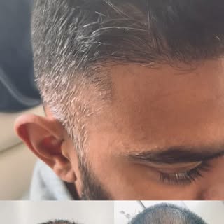 1 Year Post-FUE: This patient’s hair transplant journey shows outstanding results just one year afte