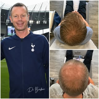 Excited to share another successful hair restoration journey for David Howells — former professional