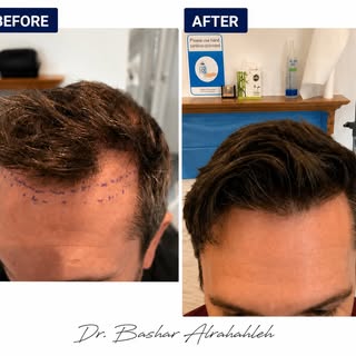 ✨ A Natural Hairline. Real Confidence. Real Results.

Hair loss doesn’t happen overnight, and neithe