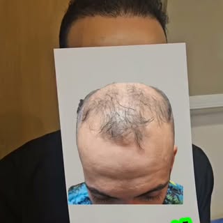 6 months after hair transplant for Grade 7 androgenetic alopecia , single session 3100 FUs with very