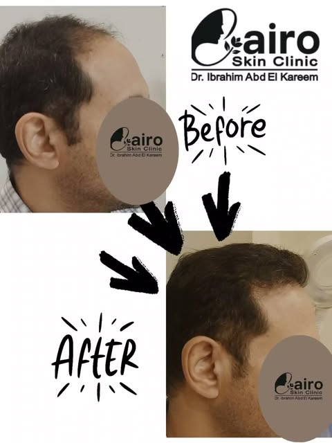 صديقى العزيز اللى طلب منى نرجع لأولى  جامعه تانى وتم التنفيذ بنجاح 😄 
زراعه الشعر بالاقتطاف